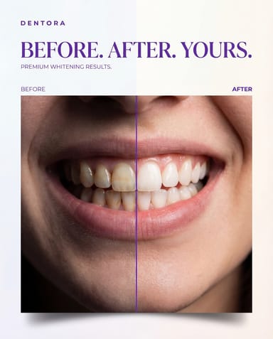 The Whitening Reveal